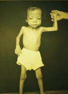 Malnourished Child